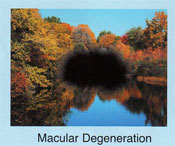 Vision with Macular Degeneration
